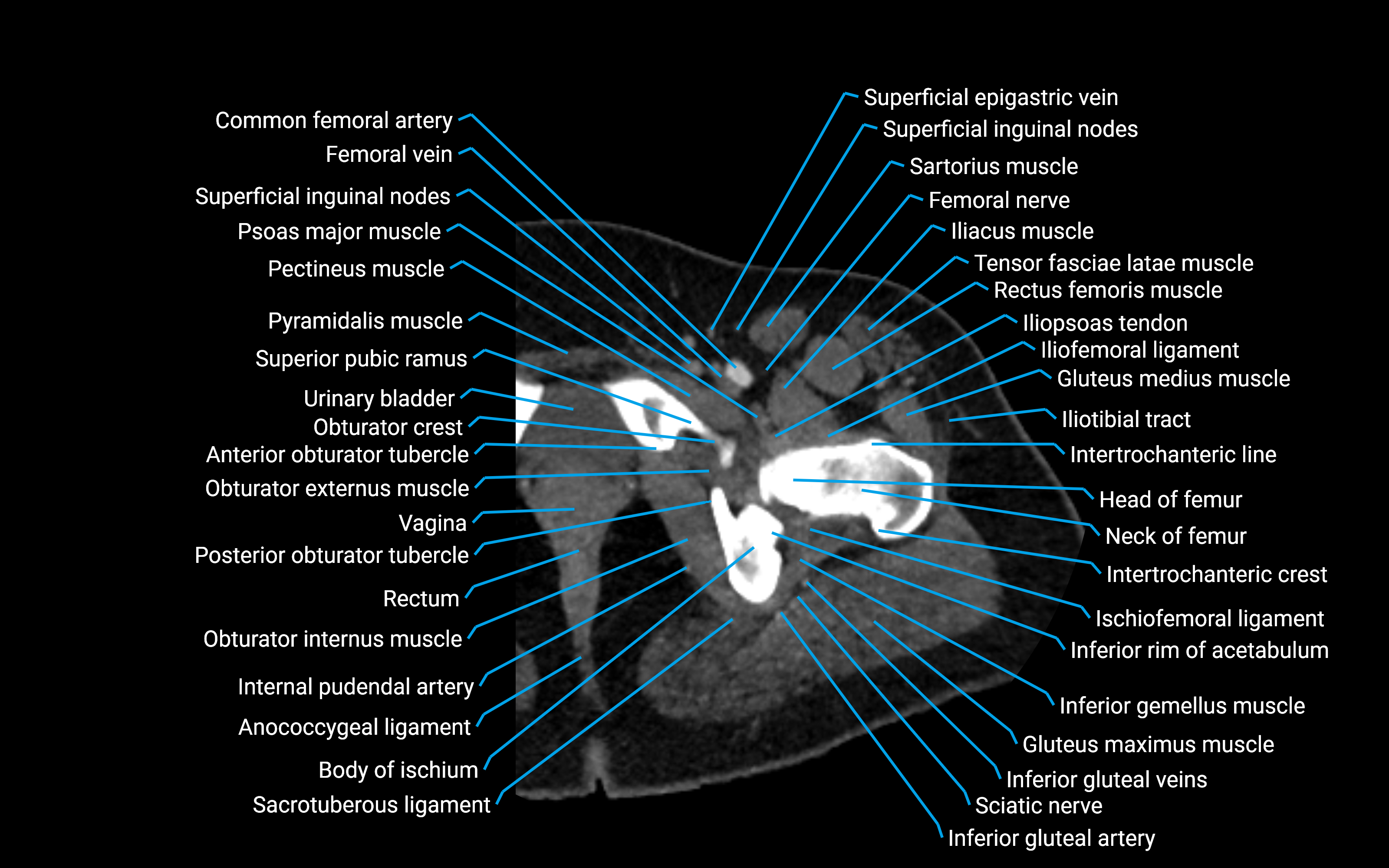 CT Hip axial cross sectional anatomy labelled image 11 (1).png